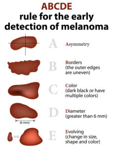 ABCDE of skin cancer detection
